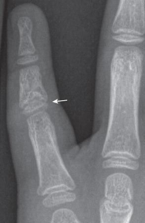 e-Figure 128.12, Cone-shaped epiphysis (arrow) of the middle phalanx of the fifth digit in a 9-year-old.