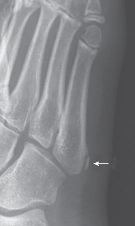 Figure 128.14, Normal apophysis of the fifth metatarsal in a 10-year-old girl (arrow) .