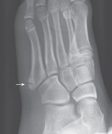 e-Figure 128.15, Bifid apophysis of the fifth metatarsal in a 13-year-old girl (arrow) .