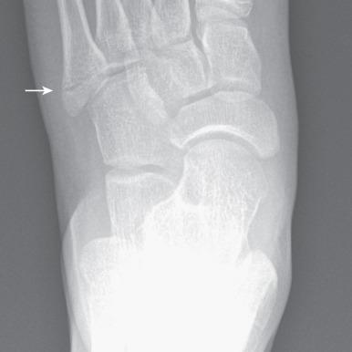 e-Figure 128.16, Nondisplaced avulsion fracture (arrow) of the base of the fifth metatarsal in a 9-year-old girl.