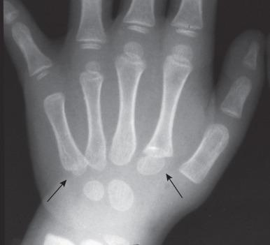 Figure 128.17, Pseudoepiphyses (arrows) in the proximal second and fifth metacarpals of a 3-year-old boy.