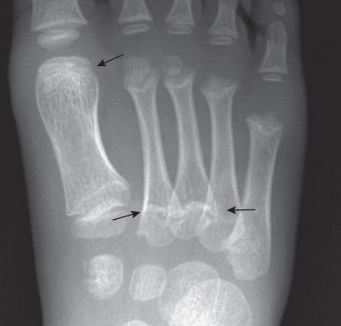 e-Figure 128.18, Pseudoepiphyses of the first metatarsal (distal arrow) and the second and third metatarsals (proximal arrows) in a 6-year-old boy.