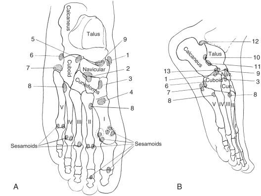 Figure 128.20, Normal supernumerary ossicles of the feet in ventrodorsal (A) and lateral (B) projections: 1, os tibiale externum (accessory navicular); 2, processus uncinatus; 3, os intercuneiforme; 4, pars peronea metatarsalia; 5, os cuboideum secundarium; 6, os peroneum; 7, os vesalianum pedis; 8, os intermetatarseum; 9, os supratalare; 10, talus accessorius; 11, os sustentaculum; 12, os trigonum tarsi; 13, calcaneus secundarius.