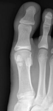 e-Figure 128.19, Bipartite medial sesamoid of the great toe in a 15-year-old boy.