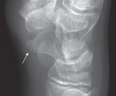 e-Figure 128.21, Accessory ossification center of the distal pole of the scaphoid (arrow) in an 11-year-old girl.