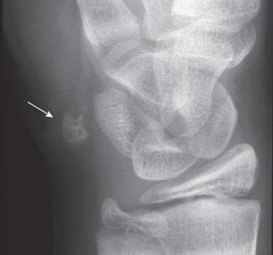 e-Figure 128.22, Irregular ossification of the pisiform (arrow) in a 12-year-old boy.