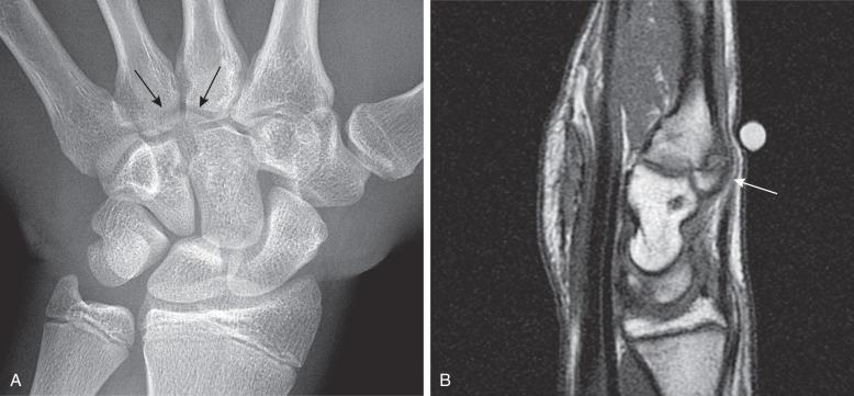 Figure 128.23, Os styloideum (carpal boss) in a 14-year-old boy.