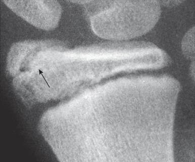 Figure 128.25, Large accessory ossification center (arrow) in the styloid process of the radial epiphyseal ossification center of a healthy 13-year-old boy.