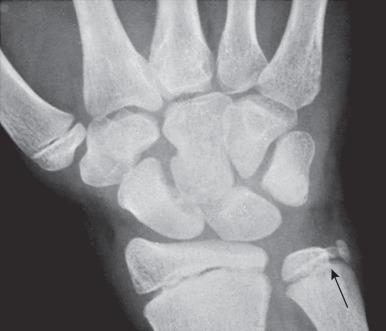 e-Figure 128.24, Separate secondary epiphyseal ossicles (arrow) for the styloid in the distal epiphyseal cartilage of the ulna of an asymptomatic 11-year-old boy.