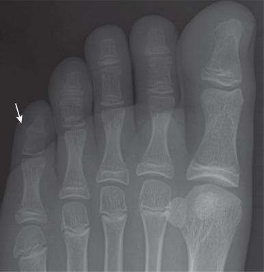 e-Figure 128.27, Biphalangeal fifth toe (arrow) in a 13-year-old girl.