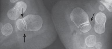 Figure 128.28, Double ossification centers (arrows) in the body of the calcaneus on each side of a 20-month-old infant.