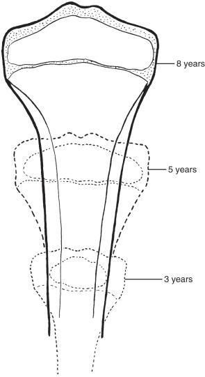 e-Figure 128.4, Growth and configuration of the tibia with advancing age.