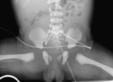 e-Figure 128.8, Normal osteosclerosis of the newborn.