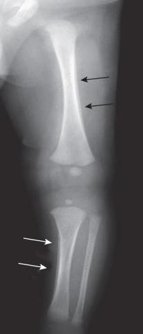 Figure 128.9, Physiologic periosteal new bone in a 9-week-old boy.