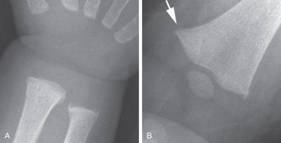 Figure 128.10, Normal metaphyseal collar.