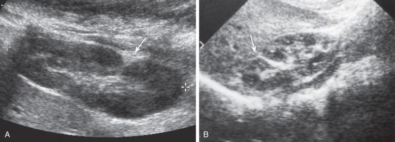Figure 110.7, Junctional parenchymal defects.