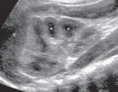 Figure 110.8, Normal neonatal kidney.