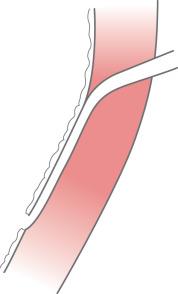 Figure 110.11, Course of the distal segment of ureter within the bladder wall.