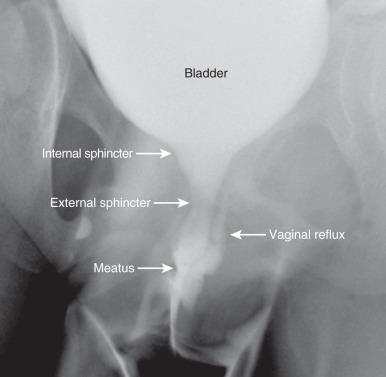 e-Figure 110.12, Normal female urethra.