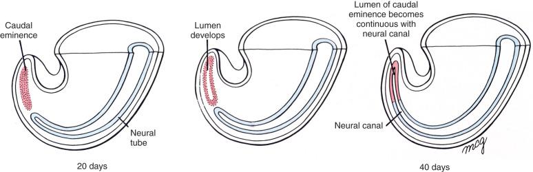 e-Figure 24.3, Secondary neurulation and formation of the neural tube inferior to the second sacral level.