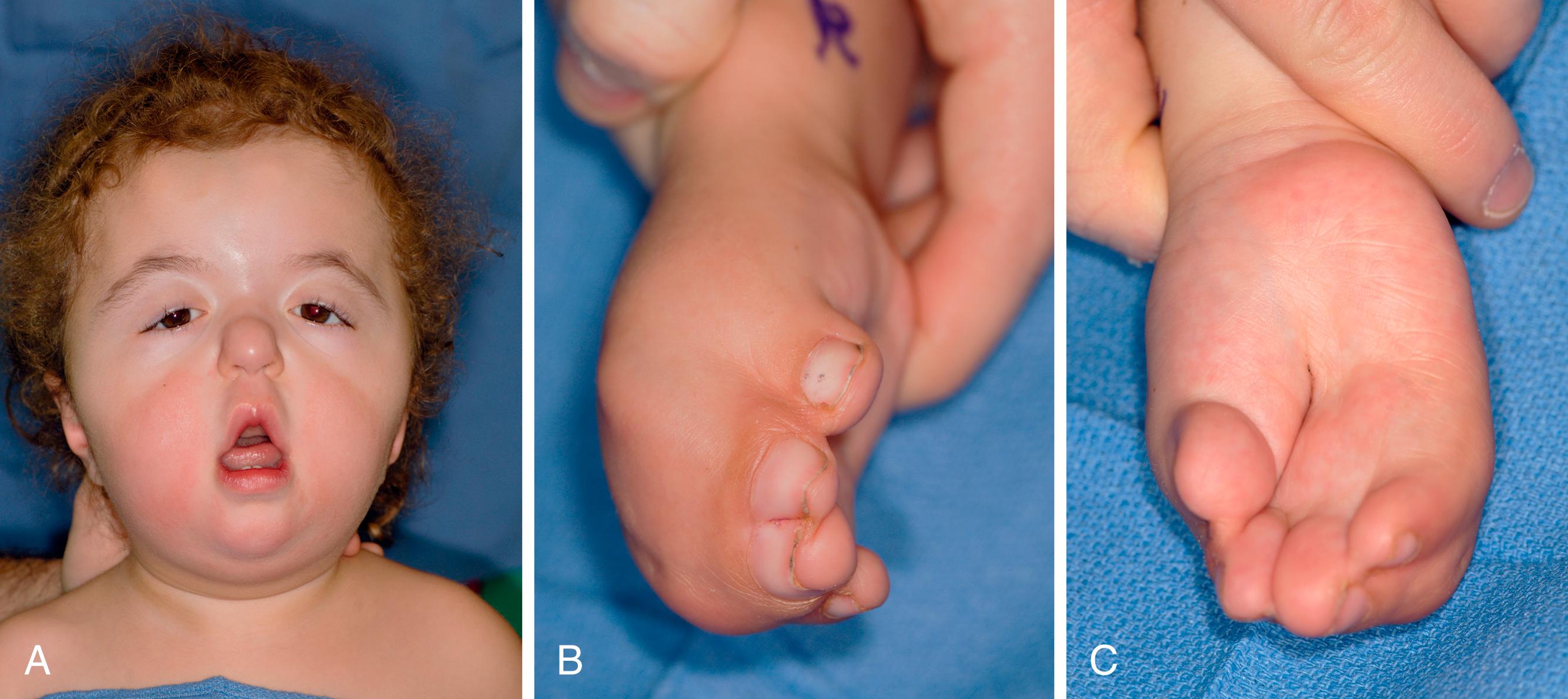 Fig. 35.2, A 2-year-old with Apert syndrome. A, Typical facies. B, Dorsal view of right hand with severe syndactyly, including web between thumb and index finger. C, Palmar view of right hand with deep crevasses.