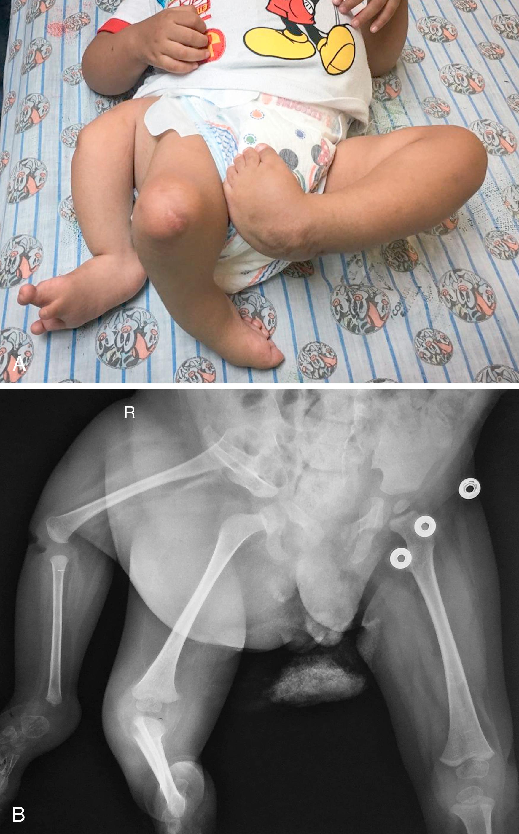 Fig. 35.6, A 2-year-old with three legs attributed to ectopic implantation of the apical ectodermal ridge (AER). A, Clinical appearance. B, X-ray.