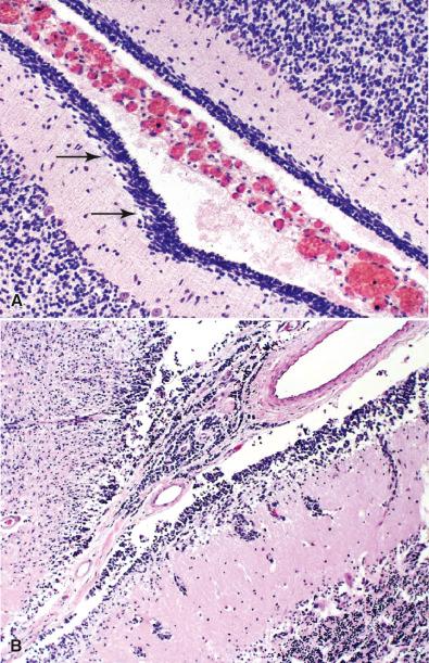 Fig. 12.3, (A) Cerebellum. Cerebellar cortex of term infant showing the external granular layer (EGL) (arrows). (B) Medulloblastoma. Extensive subpial, subarachnoid, and focal perivascular spread of a medulloblastoma.