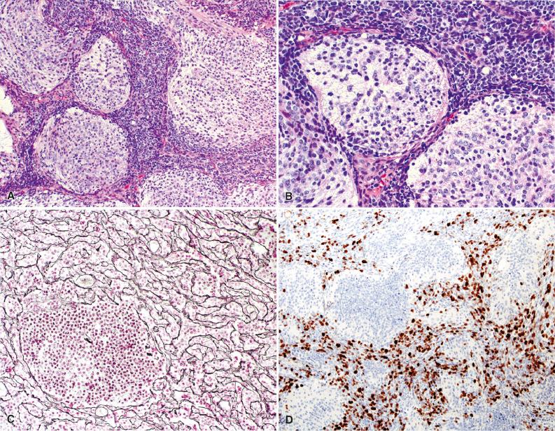 Fig. 12.5, (A) Nodular/desmoplastic medulloblastoma. Nodular “pale islands” of tumor are clearly demarcated from adjacent highly cellular tumor. (B) The less cellular nodules contain tumor cells with round nuclei and open chromatin with occasional nucleoli. Internodular areas are more cellular and primitive in appearance. (C) Reticulin stain. Hypercellular internodular regions contain abundant reticulin whereas the nodular focus to the lower left of the image is reticulin negative. (D) High proliferative activity of internodular areas is demonstrated by many Ki-67 (MIB-1) immunoreactive tumor cell nuclei compared with nodular foci showing only scattered positive nuclei. (E, F) Neuronal maturation within the nodules is highlighted with synaptophysin (E) and NeuN (F) immunostains.