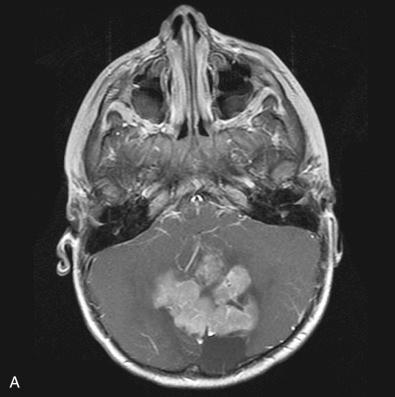 Fig. 12.7, (A) Medulloblastoma with extensive nodularity. Contrast-enhanced T1-weighted magnetic resonance imaging in an infant, showing grossly visible nodules resembling a “bunch of grapes.” (B) Low magnification view showing an expanded nodular pattern with thin internodular zones that are relatively devoid of primitive elements. (C) Rows of mature neurocyte-like tumor cells with nuclei that contain granular chromatin and small nucleoli, set within a neuropil-like stroma. Such cells are weakly proliferative. (D) Specimen from rebiopsy of an extensively nodular medulloblastoma after treatment showing complete maturation into a tumor resembling ganglioglioma.