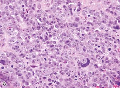 Fig. 12.8, (A) Large cell medulloblastoma. Highly cellular neoplasm with large nuclei that contain prominent nucleoli. Cell wrapping is seen at the lower right corner of the image. (B) Areas with large cell appearance (upper left) can coexist with regions of more classic histology (lower right). (C) Anaplastic medulloblastoma. Striking nuclear pleomorphism and atypical mitoses are features of anaplasia in medulloblastoma. (D) Large cell/anaplastic medulloblastoma. Distinctive cell wrapping is a feature of anaplasia in medulloblastoma. (E) Severe anaplasia with multinucleation and “cannibalism” (central region), wherein some tumor cells phagocytose their neighbors. (F) Note the apoptotic lakes (collections of pyknotic nuclei) in this large cell medulloblastoma.