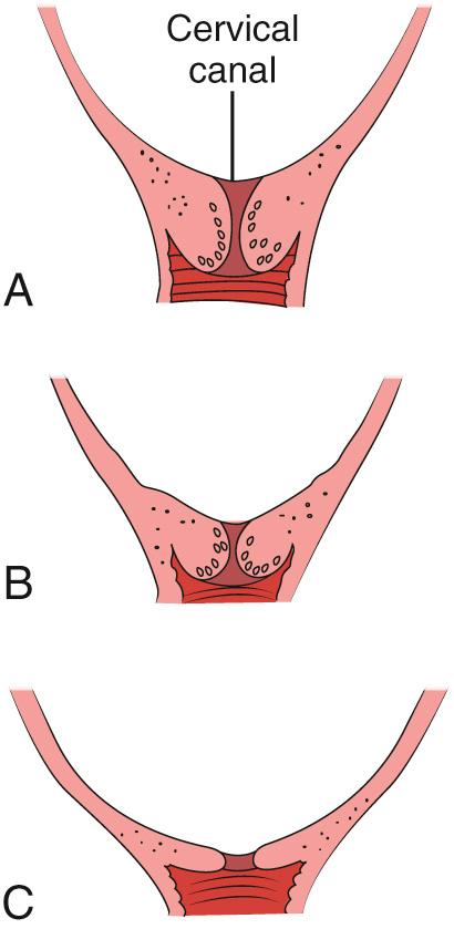 Figure 56.6, Effacement of the cervix. A, None. B, Partial. C, Complete.