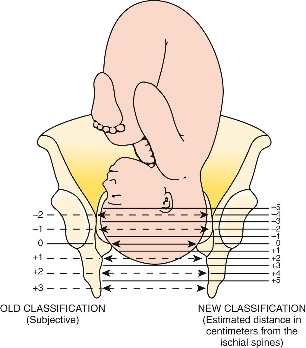 Figure 56.7, The relationship of the leading edge of the presenting part of the fetus to the plane of the maternal ischial spines determines the station. Old and new classification are included.