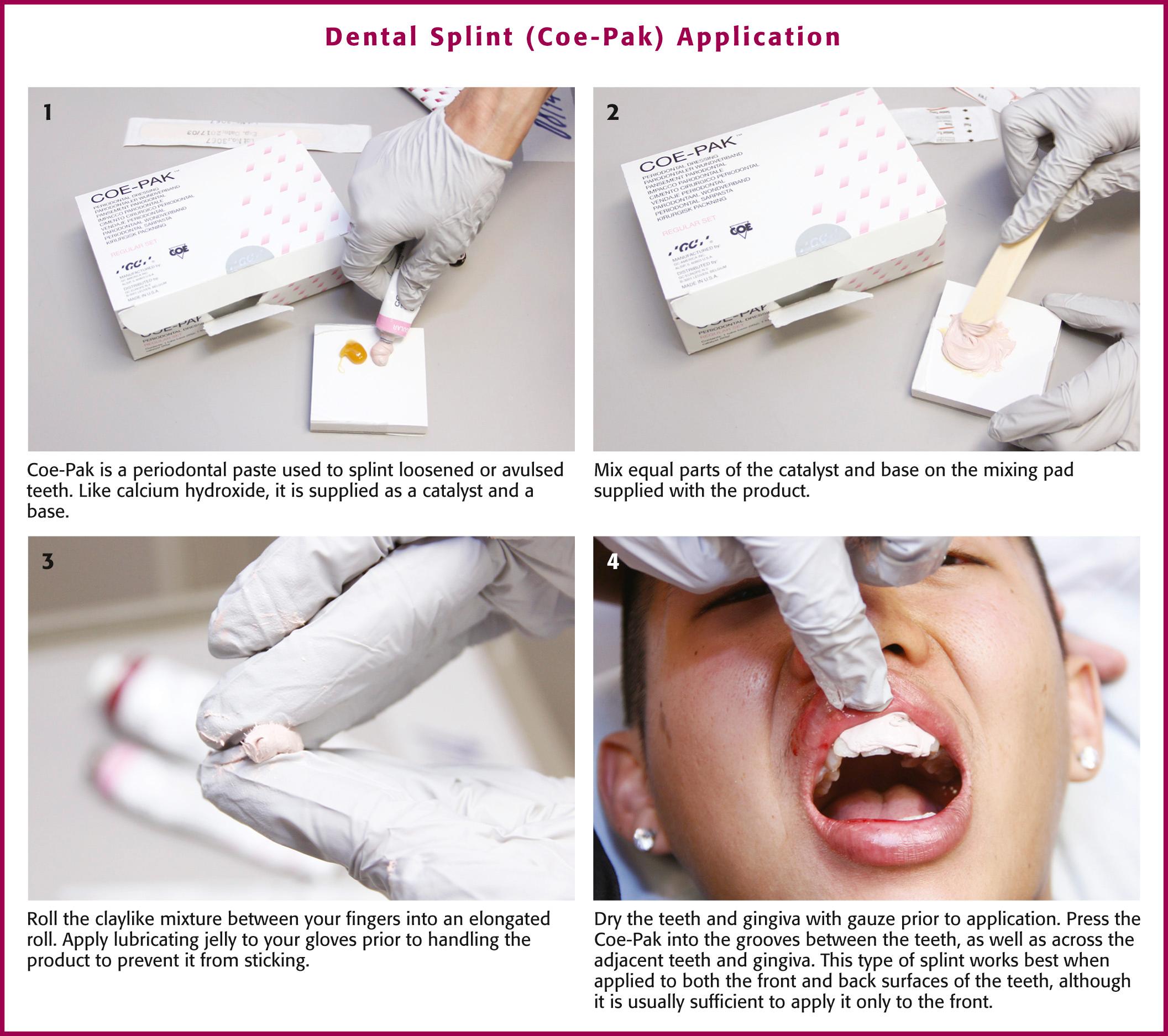 Figure 64.11, Dental splint (Coe-Pak, GC America Inc., Alsip, IL) application.
