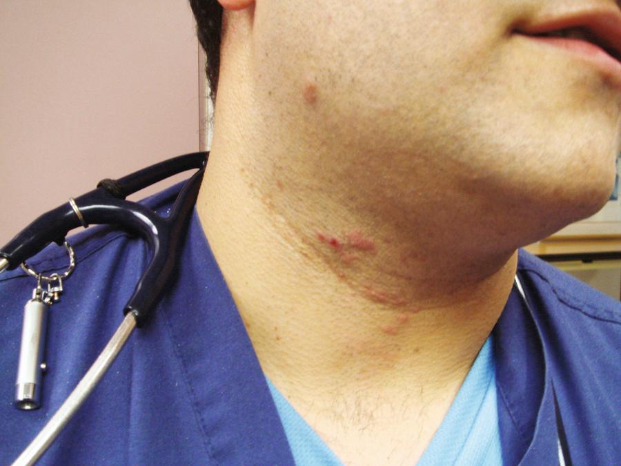 Figure 64.4, This physician had severe pain in his jaw thought to be related to a dental problem. Two days after onset of the pain, the rash of herpes zoster appeared, which was the cause of the pain.