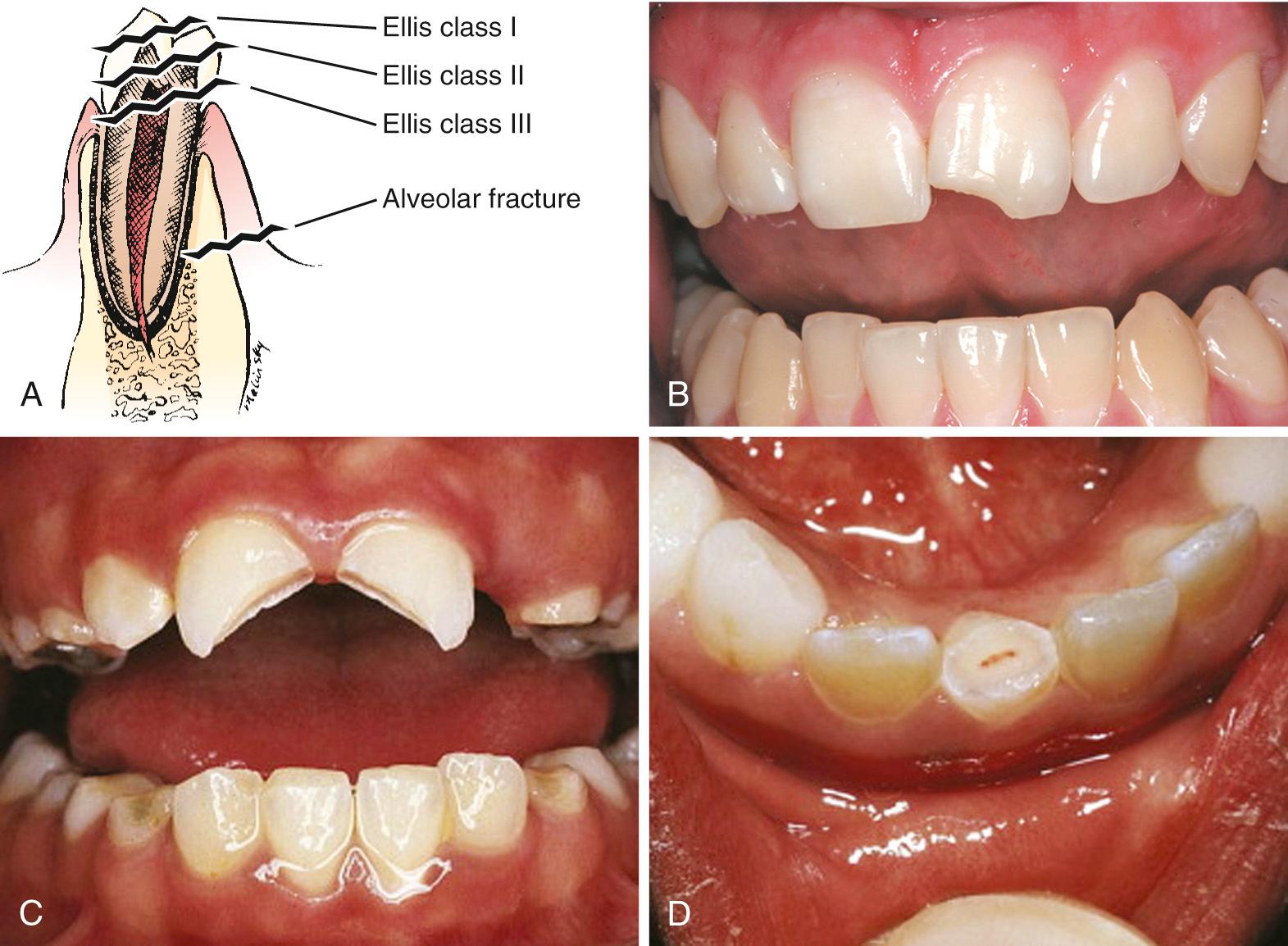 Figure 64.6, A, The Ellis classification for fractured alveolar teeth. The easiest method to classify fractured teeth is by description (e.g., fracture through the dentin of the first upper right molar). B, Ellis class I: only the enamel is fractured. These fractures pose no threat to the dental pulp and are not sensitive to temperature or forced air. C, Ellis class II: the crown fracture demonstrates involvement of the enamel and dentin, without exposure of the pulp. Immediate dental referral is necessary to prevent contamination of the pulp through the dentinal tubules. D, This crown fracture involves enamel, dentin, and the soft tissue of the pulp as well. Immediate dental referral is mandatory to save the tooth.