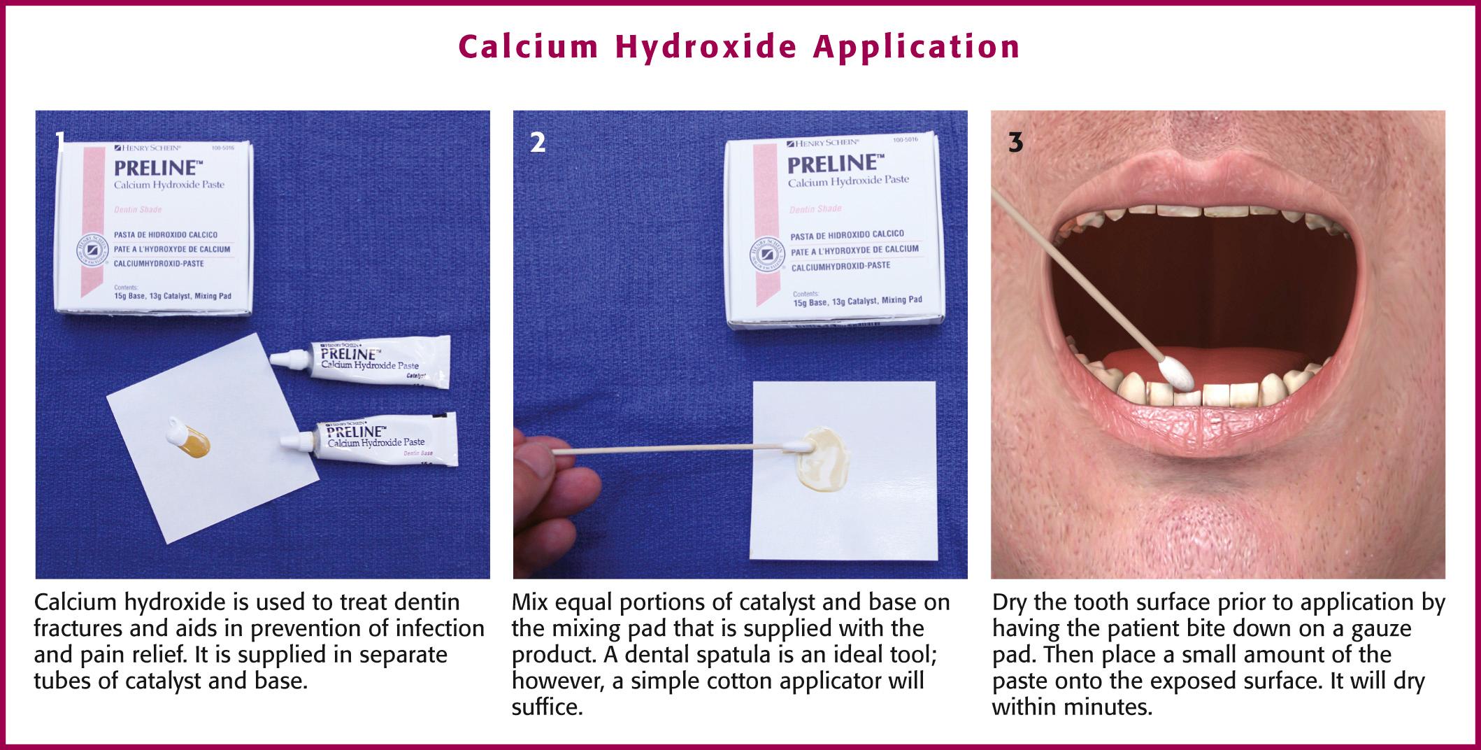 Figure 64.7, Calcium hydroxide application for the treatment of dentin fractures.