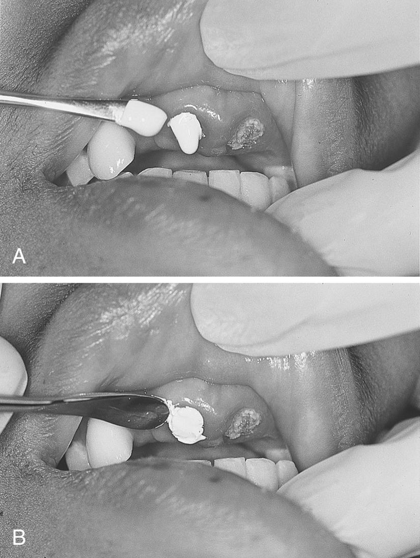 Figure 64.8, Application of periodontal calcium hydroxide paste to the fractured surface of the tooth. The paste hardens quickly in the moist environment of the mouth.