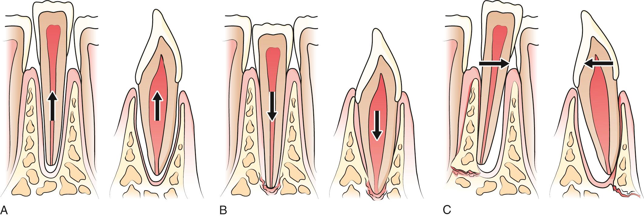 Figure 64.9, Classification of tooth trauma. A, Extrusive luxation occurs when the tooth is forced partially out of the socket in an axial direction. B, Intrusive luxation of a tooth compresses the periodontal ligament and vascular supply of the pulp. It may even crush the apical bone. C, Lateral luxation occurs when the tooth is displaced in a lingual, mesial, distal, or facial direction. Fractures of the alveolus frequently accompany lateral luxation injuries.