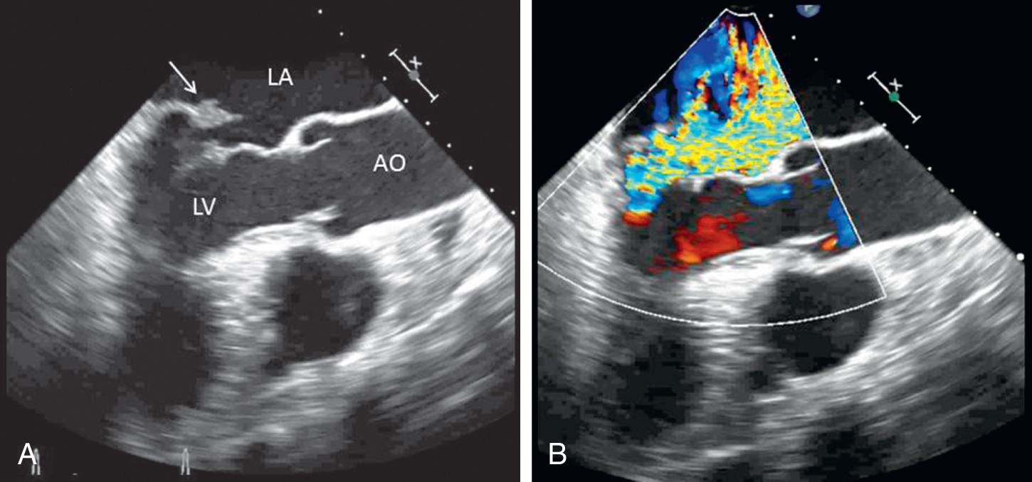 Fig. 76.3, Two-dimensional transesophageal echocardiogram (A) in a 72-year-old male with known mitral valve prolapse; ruptured chordae resulted in flail of the mitral posterior leaflet ( arrow ) and acute worsening of symptoms. Color Doppler (B) shows severe eccentric mitral regurgitation with a mosaic pattern through the noncoapting mitral valve. AO, Aorta; LA, left atrium; LV, left ventricle.