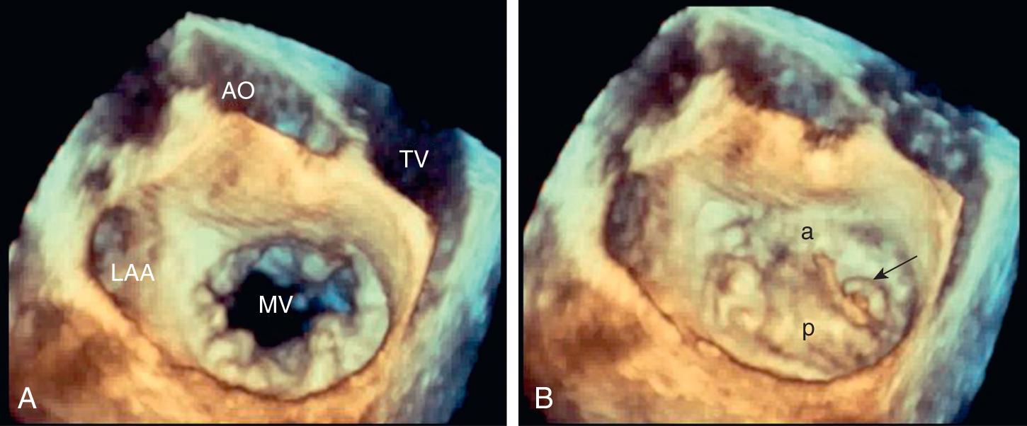 Fig. 76.4, Three-dimensional (3D) echocardiography of the same patient as in Fig. 76.3 in both diastole (A) and systole (B) . 3D imaging provided a “surgeon’s view,” allowing instant viewing of the mitral valve en face to assist operative planning for potential repair. In systole, the posterior leaflet ( p ) can be seen to prolapse above the anterior ( a ) leaflet, and ruptured chordae with flail segments can be seen (arrow). AO, Aorta; LAA, left atrial appendage; MV, mitral valve; TV, tricuspid valve.