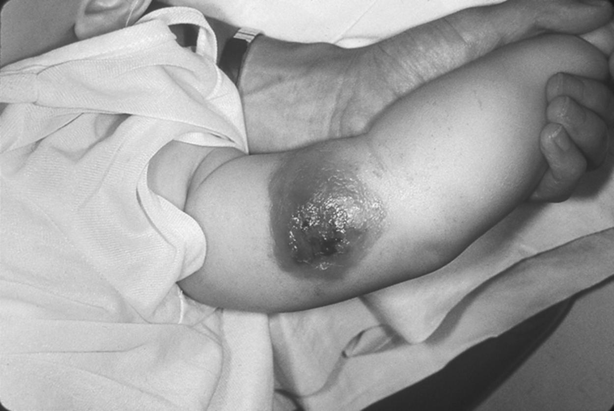 Fig. 5.1, Cutaneous anthrax in a child.