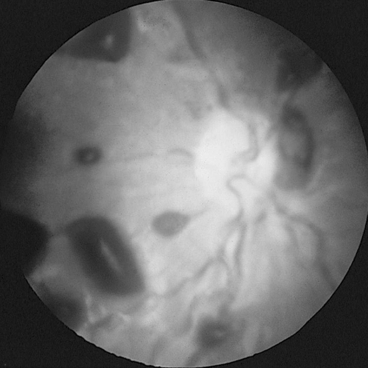 Fig. 5.2, Retinal hemorrhages of victim of abusive head trauma.