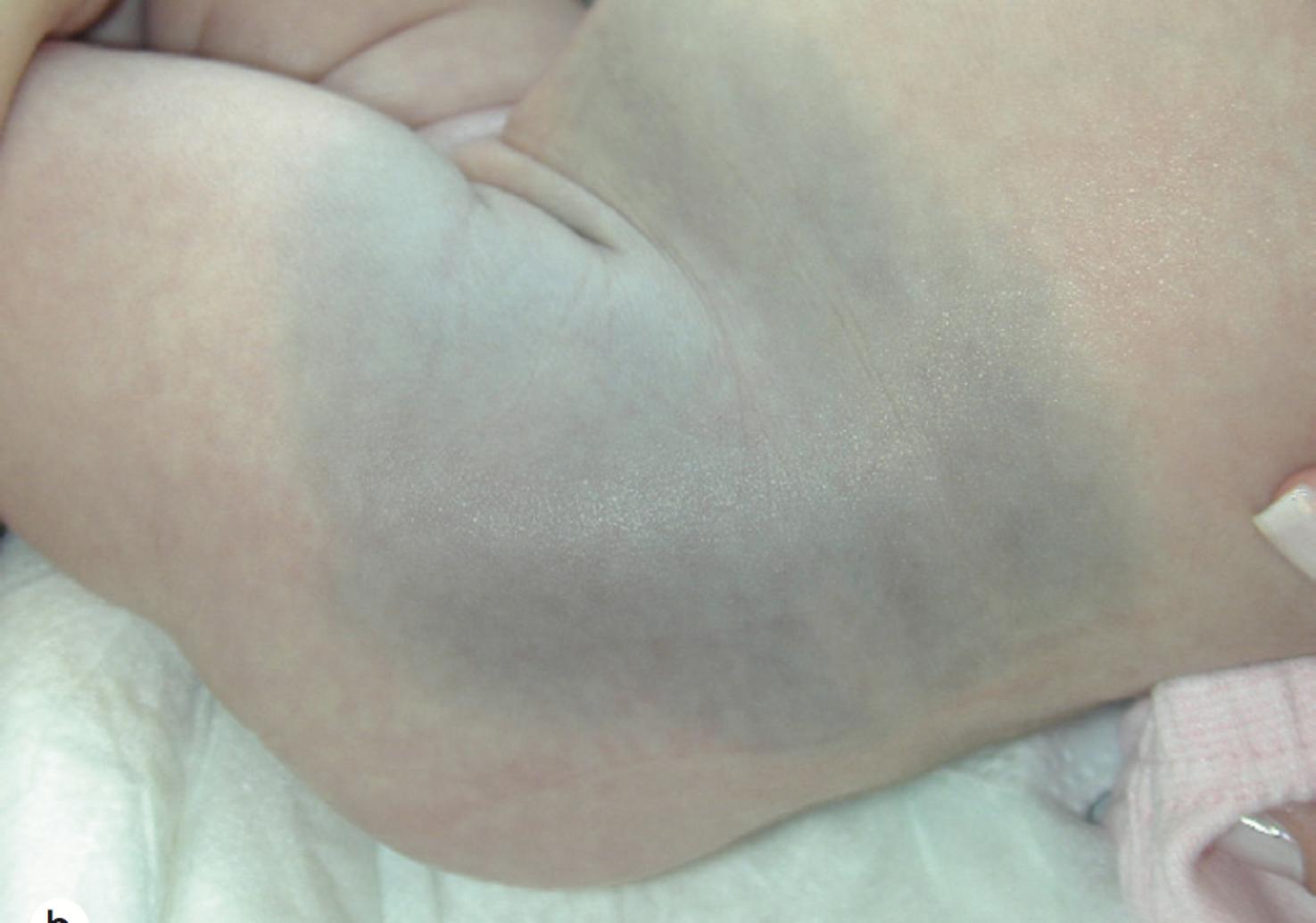 Fig. 5.3, Dermal melanocytosis (Mongolian spot) on the left hip and abdomen of a light-pigmented infant.