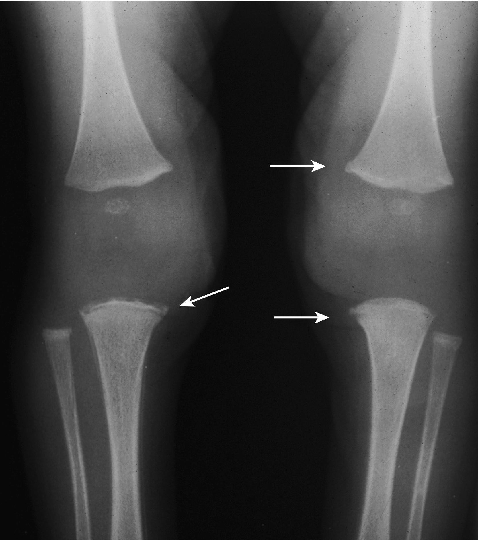 Fig. 5.4, Radiograph of classic metaphyseal (arrows) lesions.