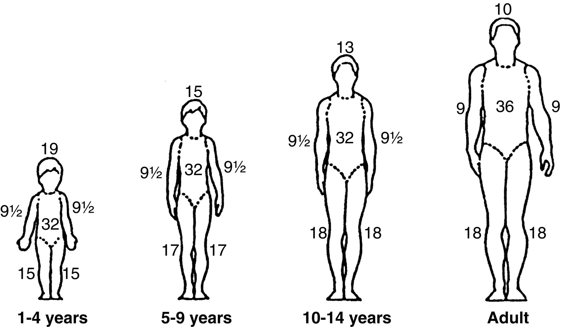 Fig. 5.5, Rule of nines as applied to children.