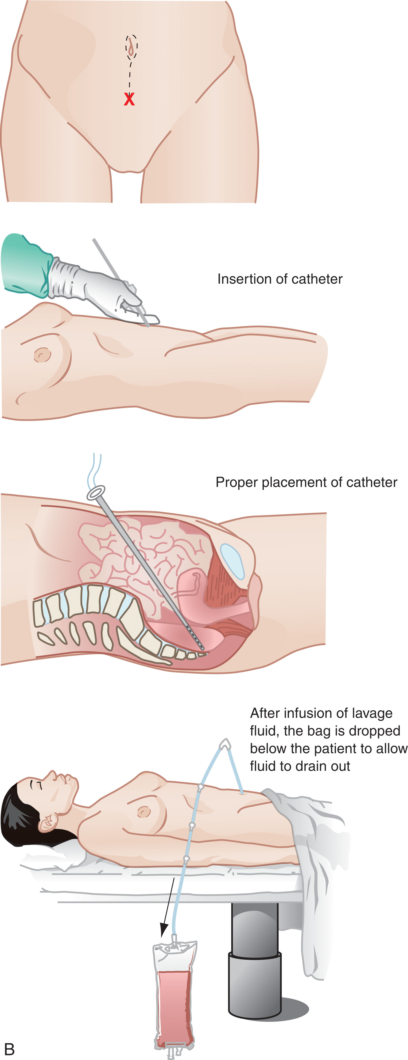 Fig. 19.1, Peritoneal lavage. The incision is made either in the midline or at the paraumbilical site with multiple layers of tissue penetrated before the parietal peritoneum is located.