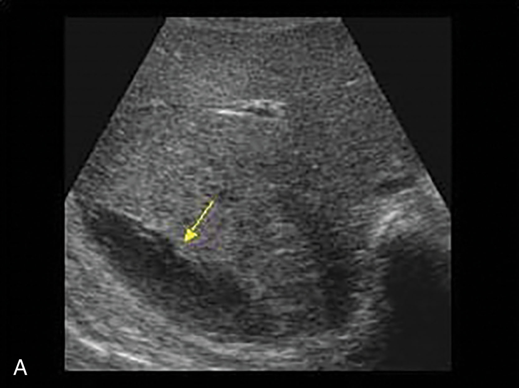 Fig. 19.11, Liver lacerations or contusions are more easily detected with ultrasound than any other visceral abdominal injury. Hematomas and localized lacerations will appear initially hypoechoic with low-level echoes generated from the red blood cells, or echogenic, as the blood begins to coagulate, which over time will become more anechoic with the onset of hemolysis. (A – B) Transverse images with ultrasound and computed tomography show a fluid collection along the posterior border from a liver laceration. (C–D) The liver laceration is located within the right lobe of the liver.