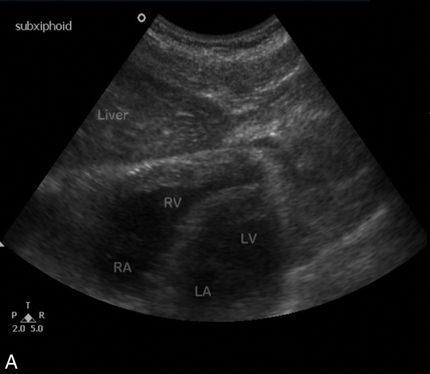 Fig. 19.4, The initial survey is directed in the subcostal plane with the transducer angled in a cephalic direction toward the four-chamber view of the heart to image the pericardial sac. (A) Subcostal view shows no evidence of pericardial fluid. (B) Moderate pericardial fluid seen within the pericardial sac (arrows) , as well as right atrial collapse (curved arrow) that indicates impending tamponade. LA, Left atrium; LV, left ventricle; RA, right atrium, RV, right ventricle.