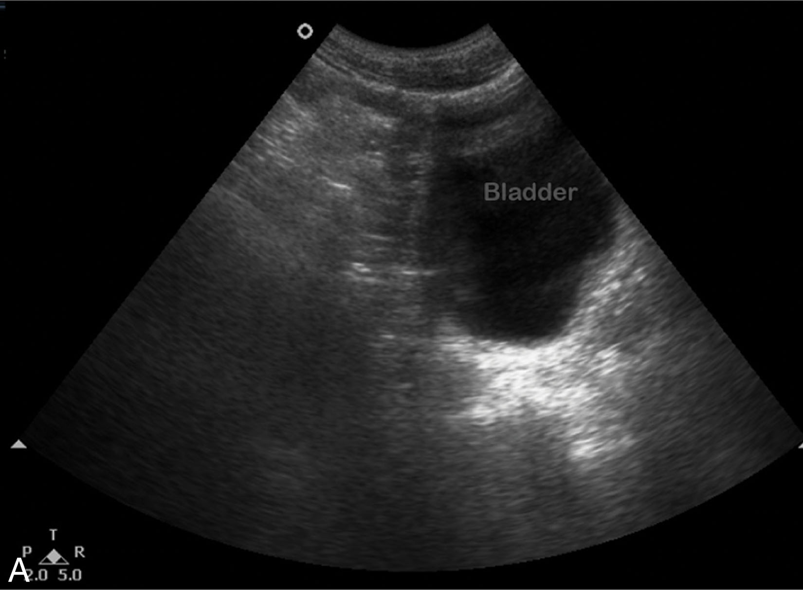 Fig. 19.7, The bladder is filled via a urinary catheter to image the pelvic region for the presence of free fluid. (A) Suprapubic image in the longitudinal axis on a male. (B) Transverse image of the distended bladder with free fluid outside the wall.