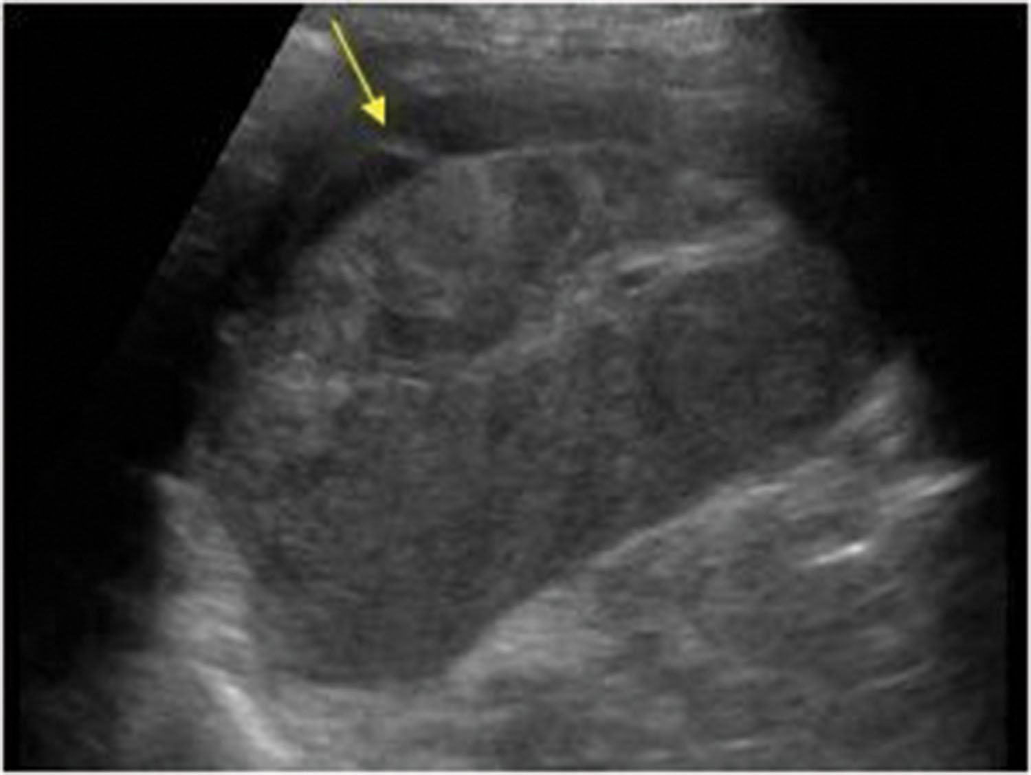 Fig. 19.8, Subcapsular hematoma of the spleen. The fluid is usually hypoechoic or hyperechoic, with scattered internal echoes representing the blood, and conforms to the anatomic site it occupies.